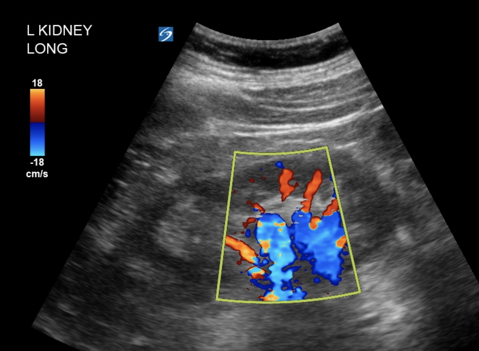 How to Scan the Renal Tract :: POCUS